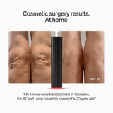 The LYMA Laser